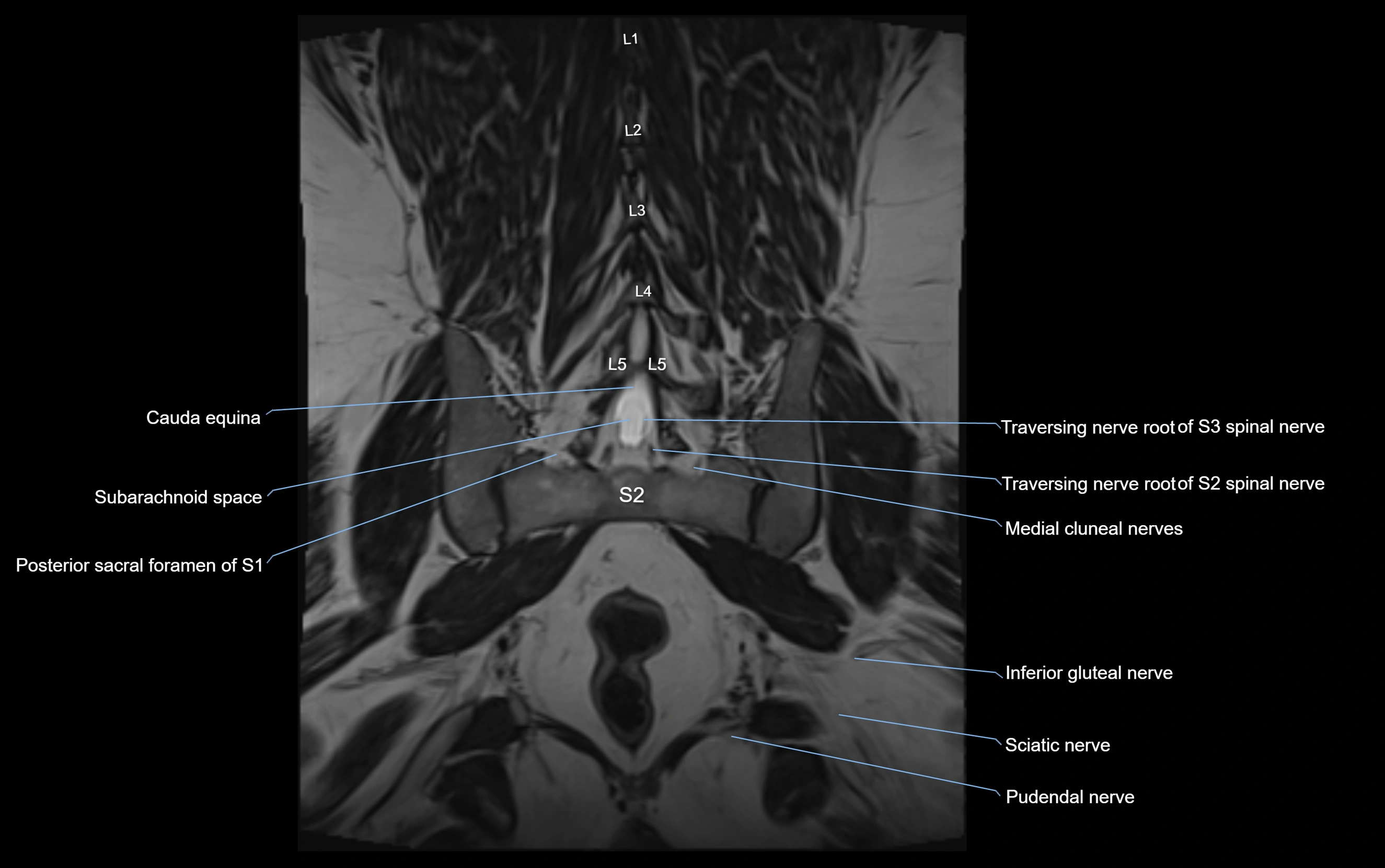 MR lumbosacral plexus cross sectional anatomy 3T  radiology  image-img-09001-00056.webp